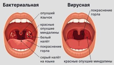 Осложнения у детей при ангине и отите