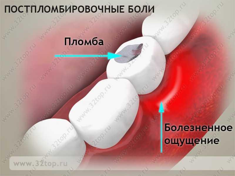 Постпломбировочные боли в стоматологии