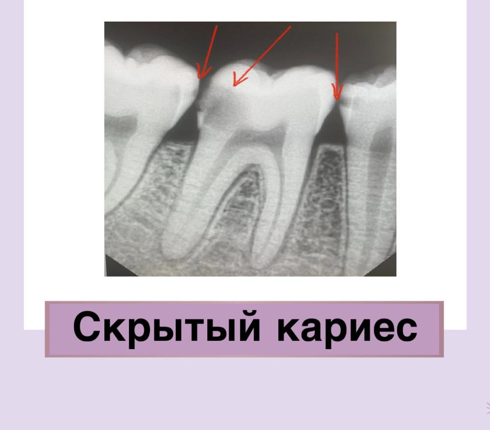 Скрытый кариес