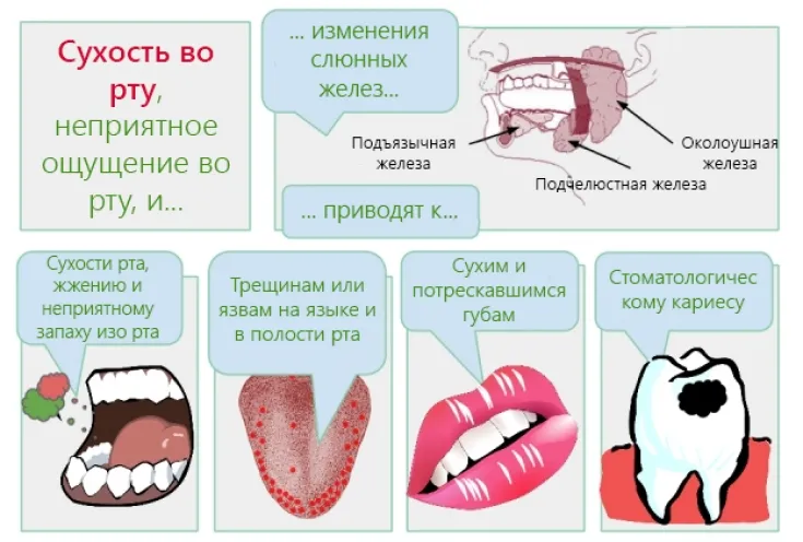 Сухость во рту (ксеростомия): причины и как помочь